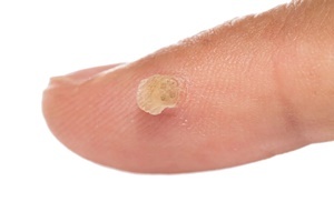 Брадавица - кожно заболяване с който ефективно се бори Skincell Pro