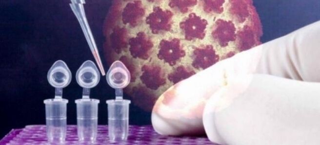 HPV диагностика с помощта на дигенен тест